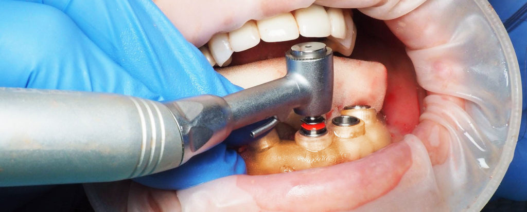3d printed surgical guide in patient mouth